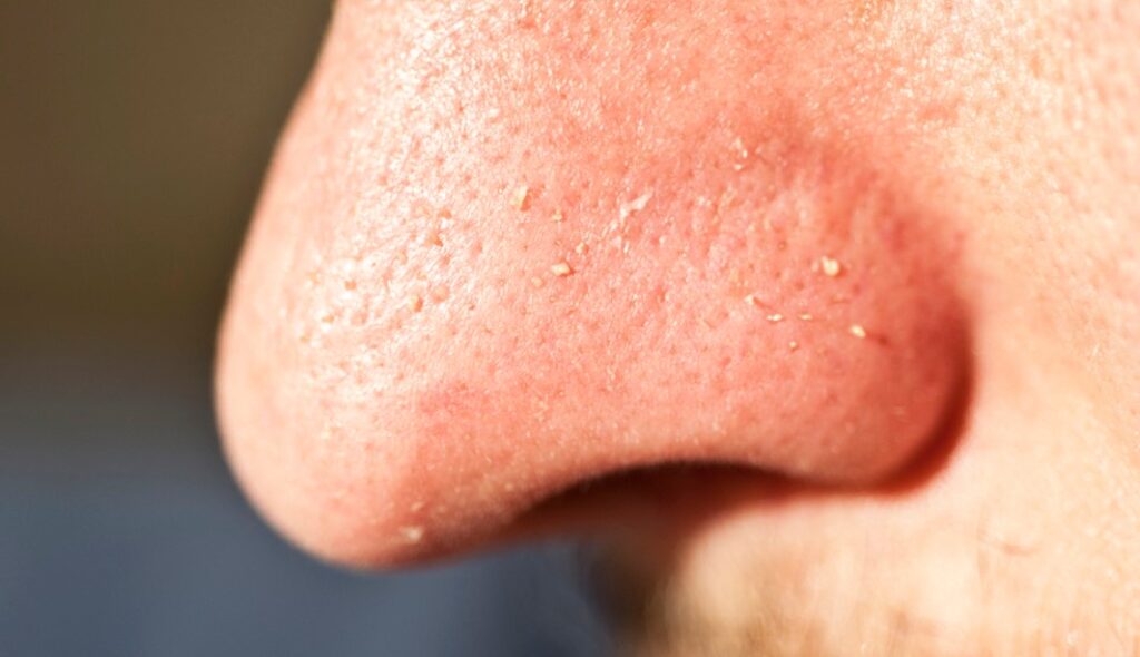 2-Cara-Menghilangkan-Komedo-Putih-di-Hidung