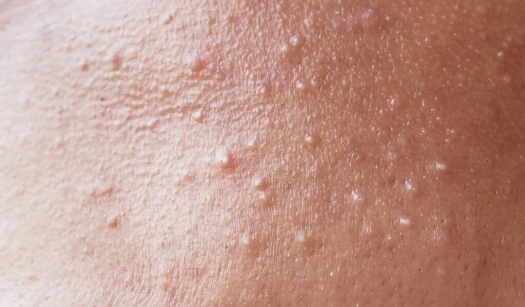 Apa-Itu-Bruntusan-dan-Mengapa-Bisa-Terjadi