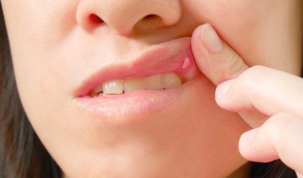 Beberapa-Cara-Mengobati-Sariawan-di-Bibir