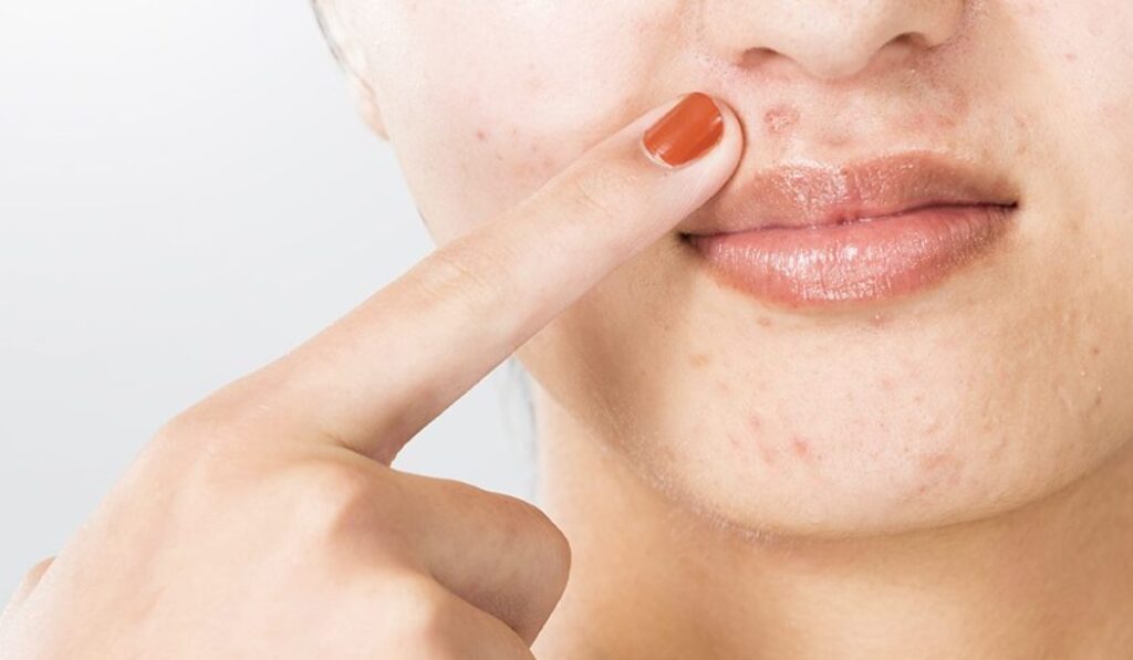 Berbagai-Cara-Hilangkan-Bruntusan-di-Wajah-dengan-Tepat