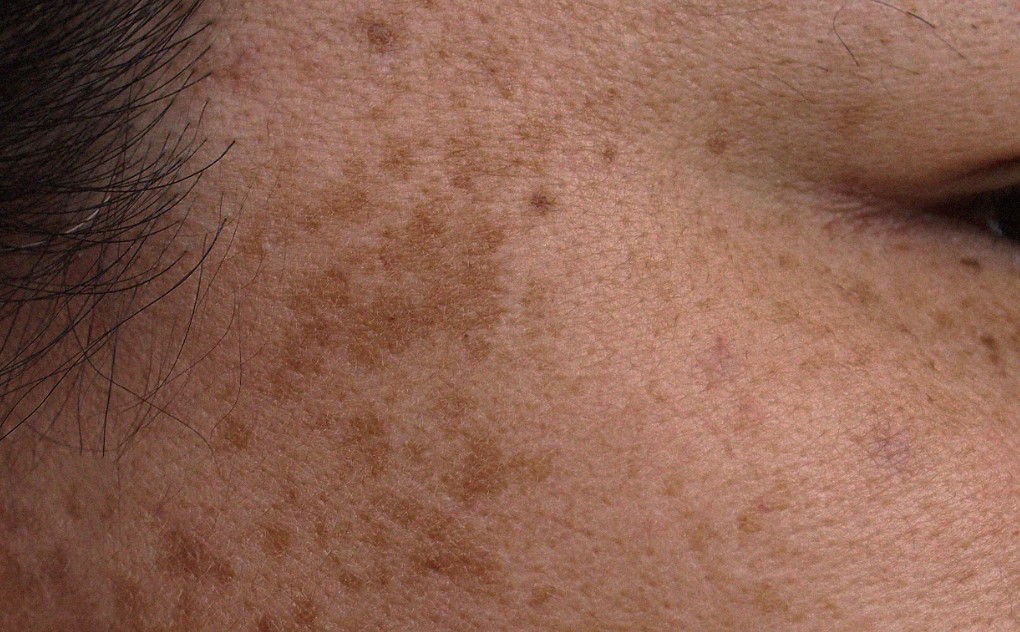 Cara-Memilih-Skincare-untuk-Mengatasi-Hiperpigmentasi-Bandel