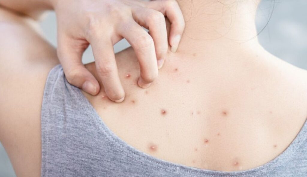 Cara-Mengatasi-Penyebab-Jerawat-di-Punggung-dengan-Produk-yang-Tepat