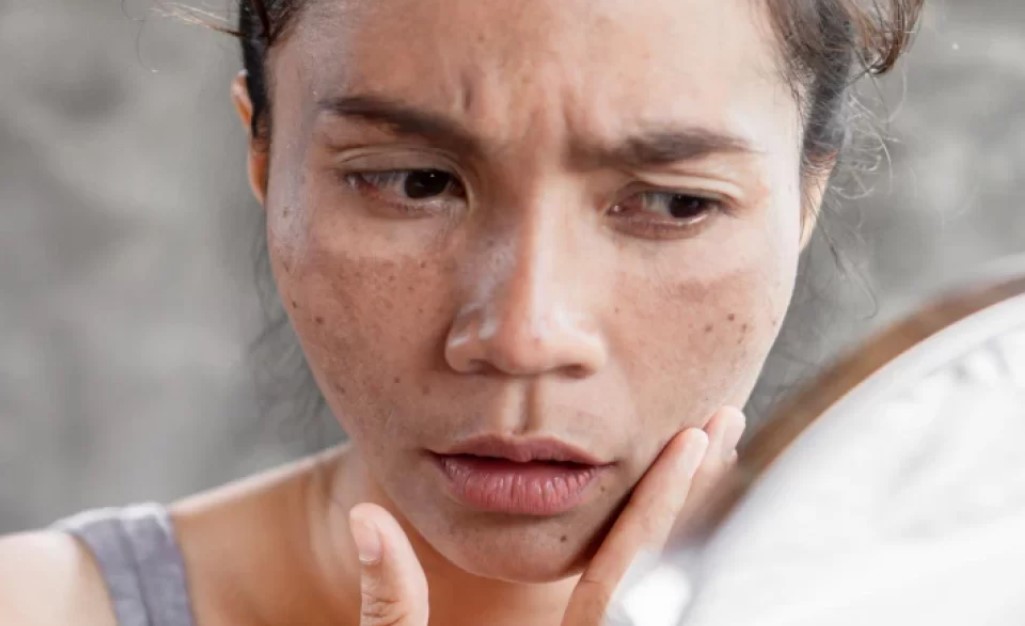 Cara-Menghilangkan-Flek-Hitam-Menahun-Tanpa-Laser-yang-Terbukti-Efektif