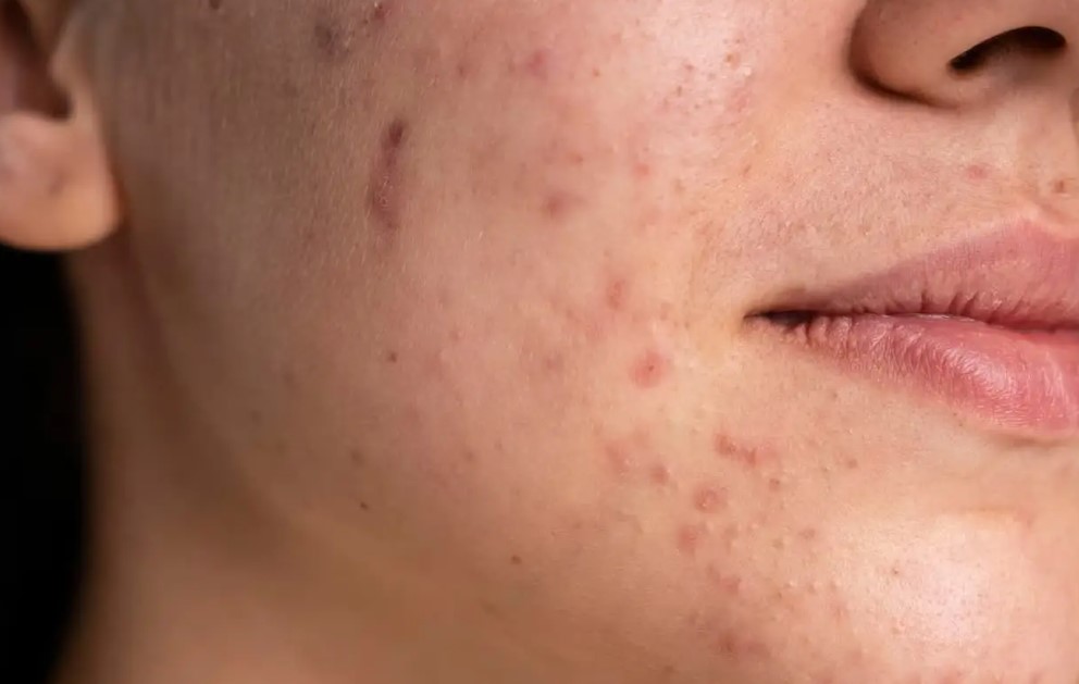 Langkah-Langkah-Mengatasi-Jerawat-Dengan-Efektif