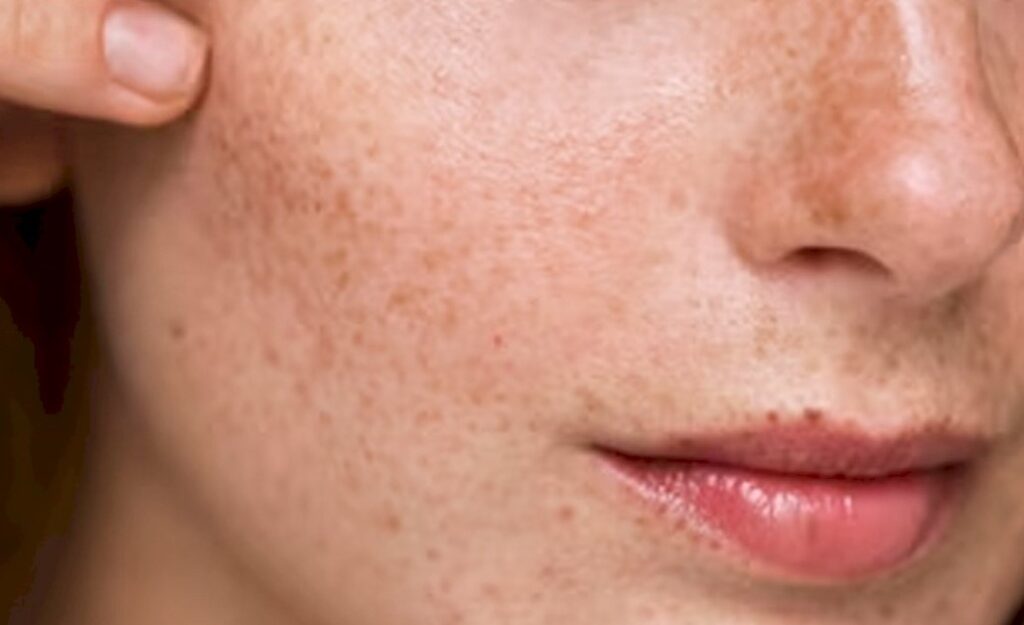 Memahami-Penyebab-Flek-Hitam-Menahun