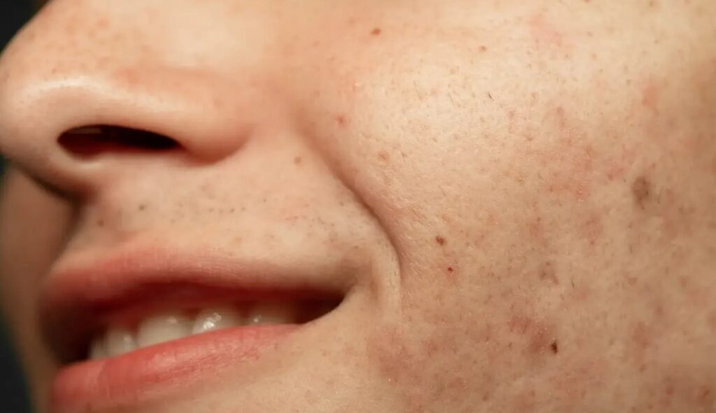 Mengapa-Perlu-Menggunakan-Skincare-Khusus-Hiperpigmentasi-Usia-40-Tahun