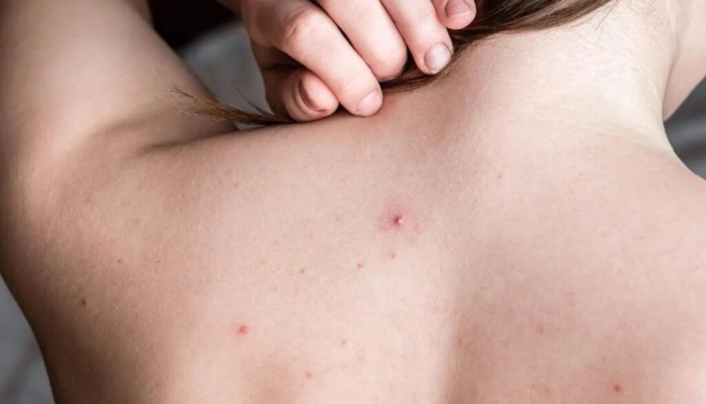Penyebab-Jerawat-di-Punggung-dan-Dada