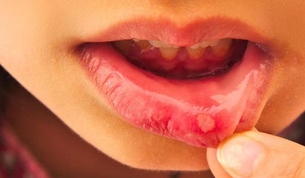 Penyebab-dan-Hal-Yang-Perlu-Dihindari-saat-Sariawan-di-Bibir