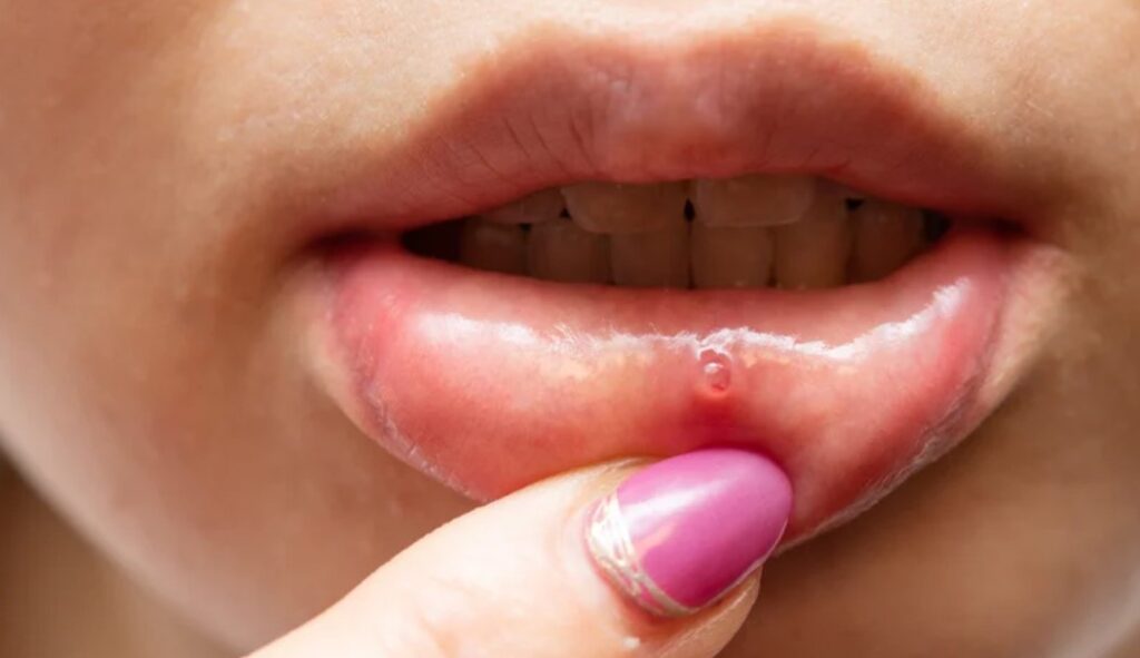 Rekomendasi-Produk-Obat-Sariawan-Bibir-Terbaik