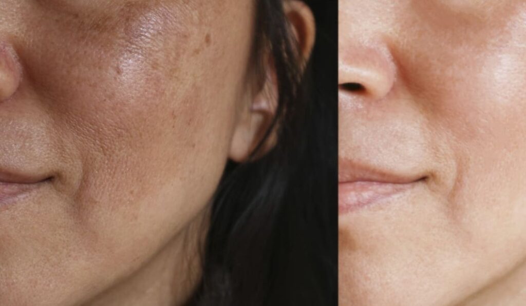 Rekomendasi-Produk-Terbaik-untuk-Menghilangkan-Flek-Hitam-Menahun-Tanpa-Laser