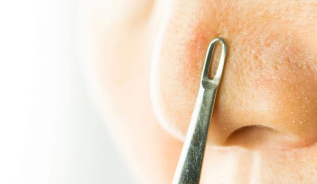 Rekomendasi-Produk-Terbaik-untuk-Menghilangkan-Komedo-Putih