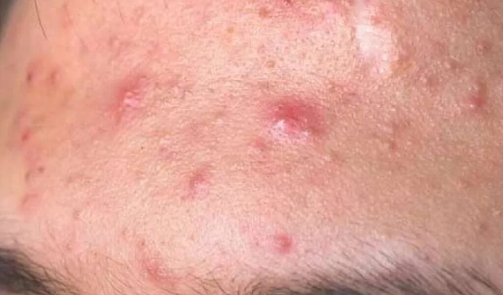 Rekomendasi-Serum-Penghilang-Bruntusan-Terbaik