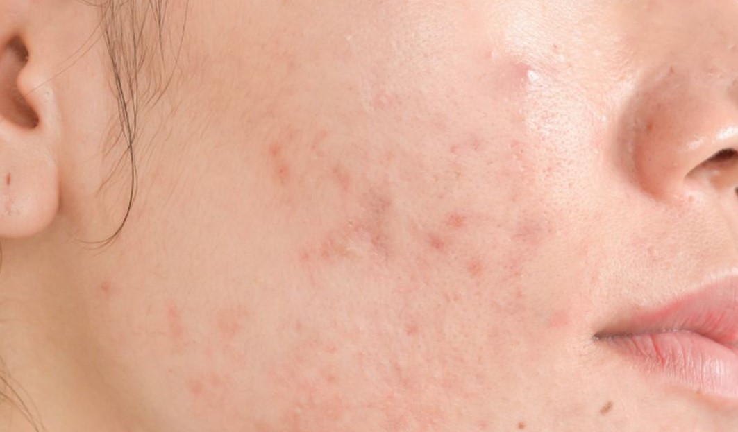 cara-hilangkan-bruntusan