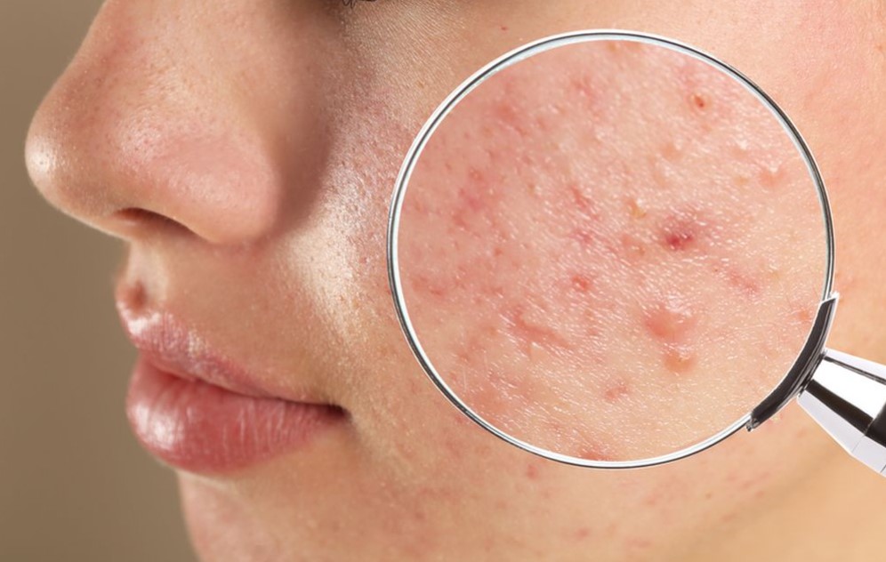 cara-menghilangkan-bekas-jerawat
