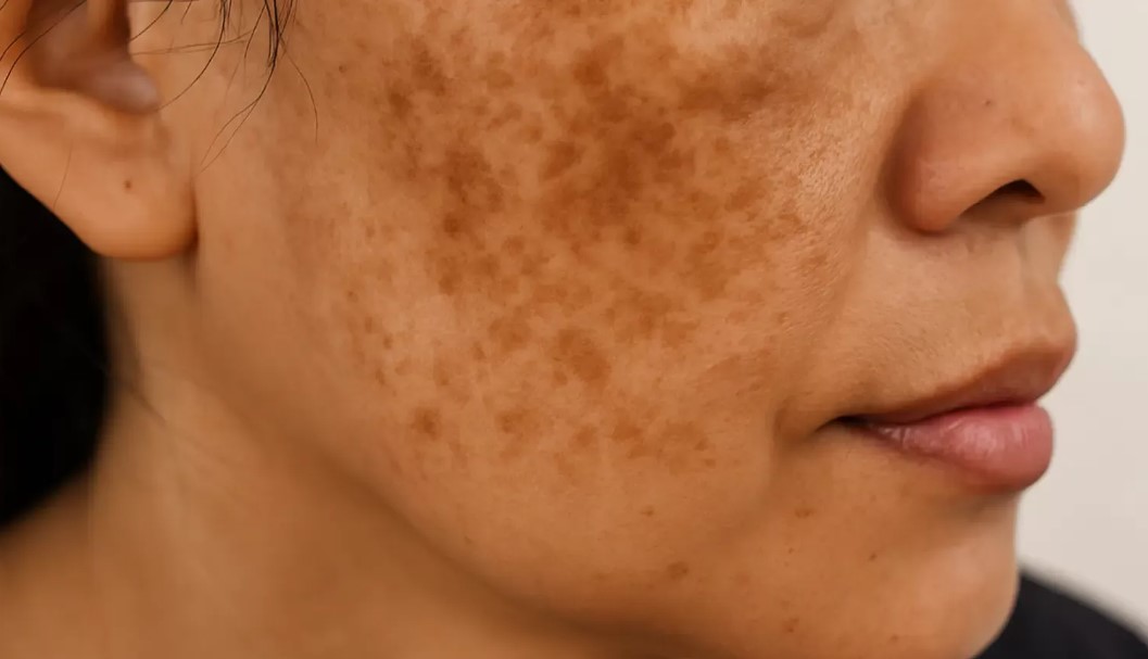 cara-menghilangkan-flek-hitam-menahun-tanpa-laser