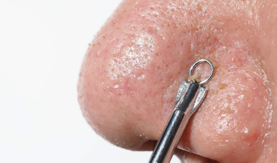 cara-menghilangkan-komedo-putih-di-hidung