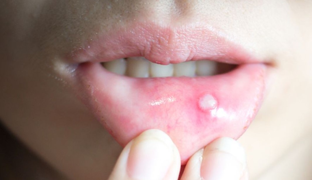 cara-mengobati-sariawan-di-bibir