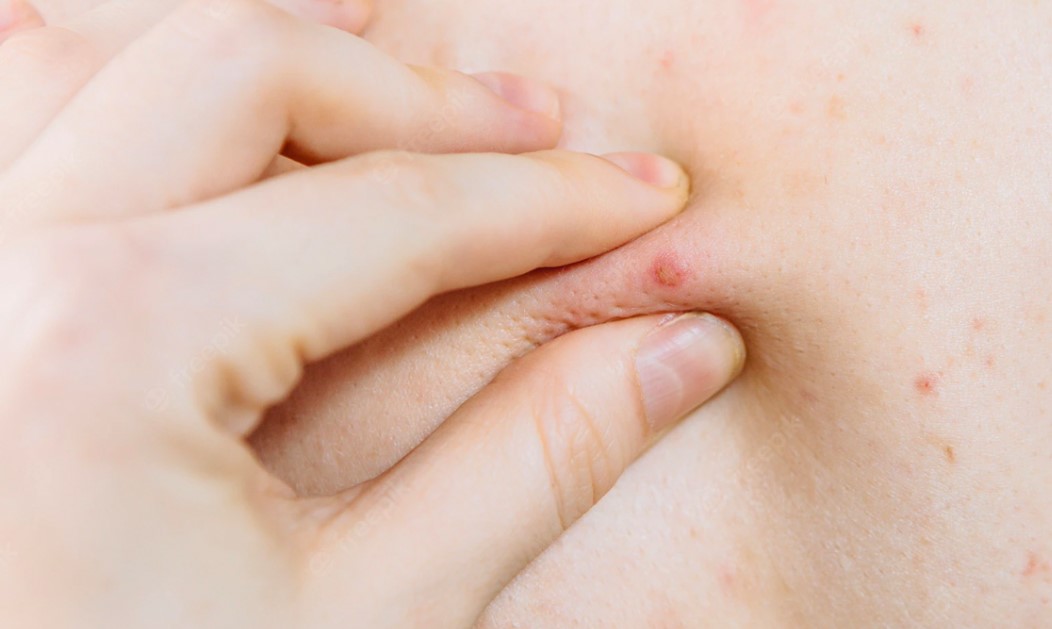 penyebab-jerawat-di-punggung