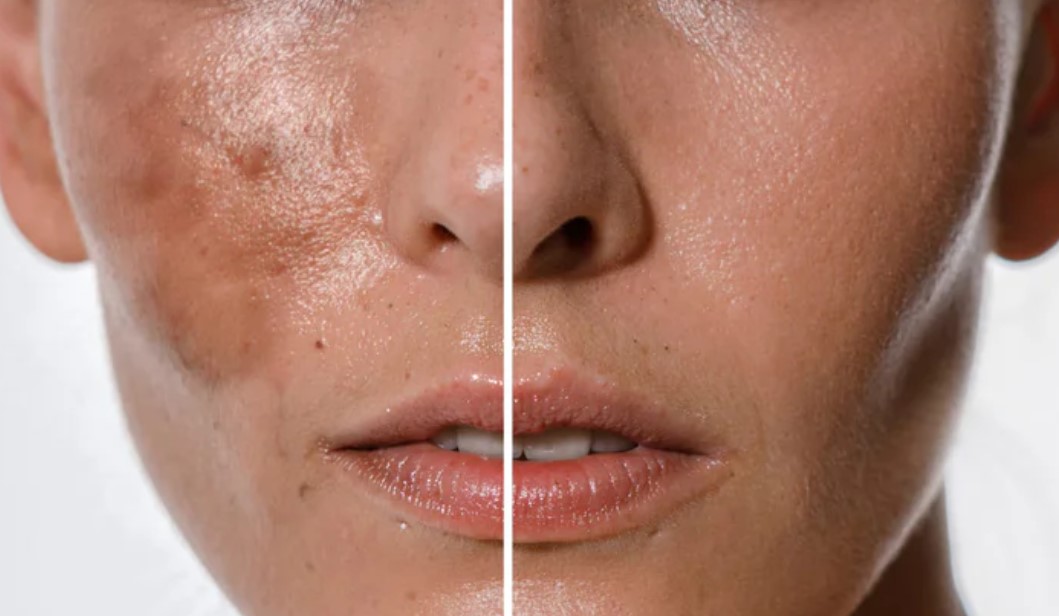 skincare-untuk-mengatasi-hiperpigmentasi-bandel